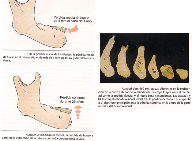 Implantes Dentales atwood